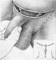 Χειρουργική επιμήκυνση του πέους με το τράβηγμα του κρυμμένου τμήματος
